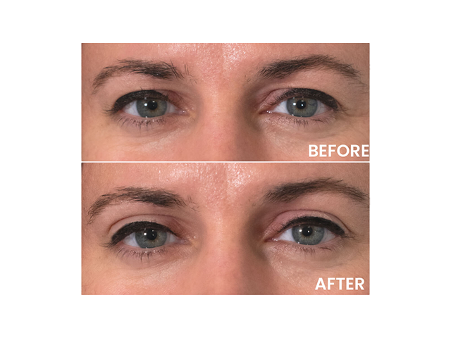 Achieve Dramatic Youthful Results